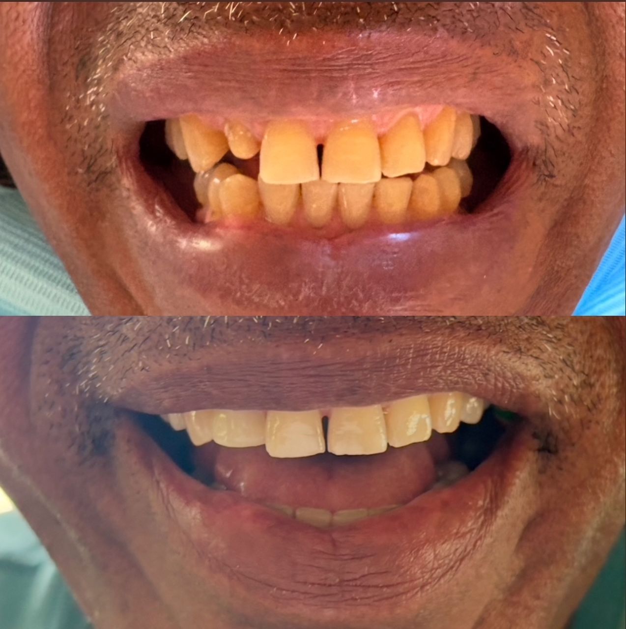 A before and after picture of a man 's teeth