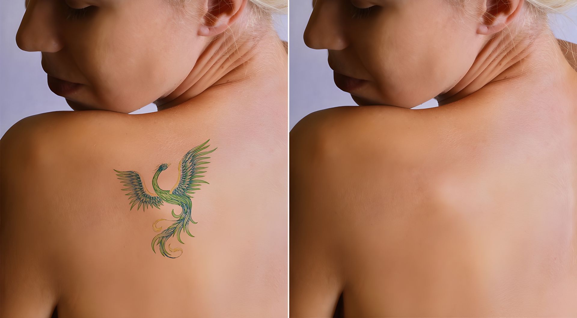 Woman's Back With A Green Tattoo Of A Phoenix On The Left, Tattoo Removed On The Right  — Tattoo Inc Studio in Robina, QLD