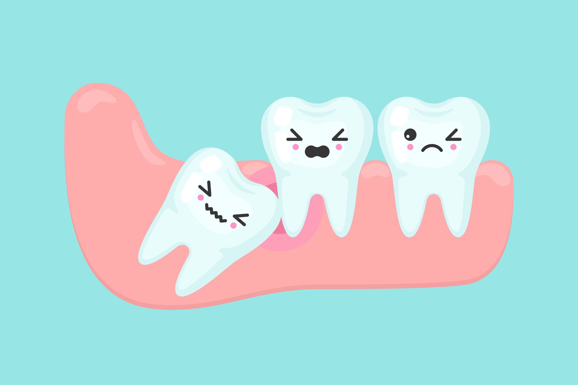 Impacted Tooth Illustration