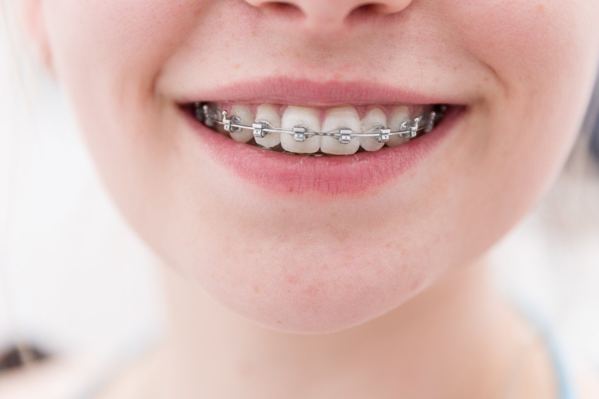 Zahnspangen versichern Übersicht über verschiedene Angebote der Zahnspangen Versicherung