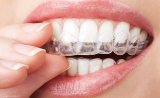 Home-Bleaching: Einsetzen der Bleaching-Folien Home-Bleaching: Einsetzen der Bleaching-Folien