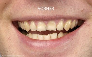 Stark abgenutzte Schneidezähne Stark abgenutzte Schneidezähne