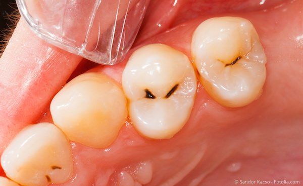 Karies auf kleinen Backenzähnen Karies auf kleinen Backenzähnen
