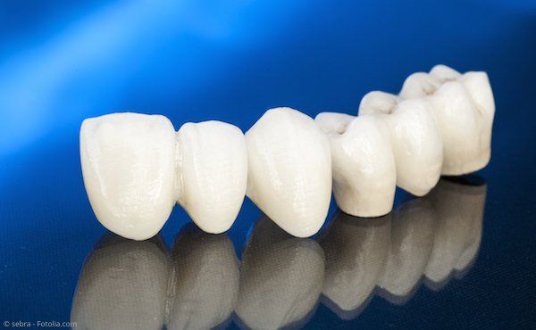 Zahnbrücke aus reiner Keramik: Ästhetisch und gut körperverträglich Zahnbrücke aus reiner Keramik: Ästhetisch und gut körperverträglich