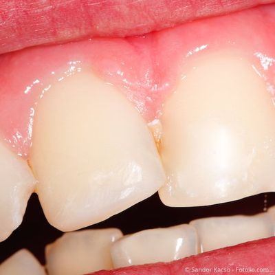 Zahn abgebrochen vom ecke Patientenfrage: kleine