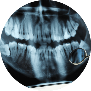 X-Ray photo of teeth