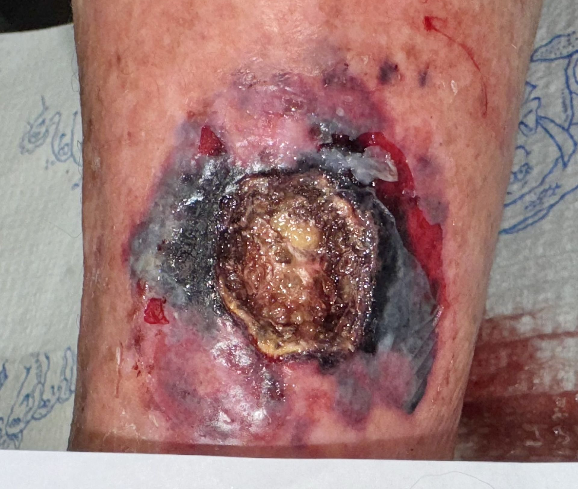 Necrotizing Fasciitis in Wound