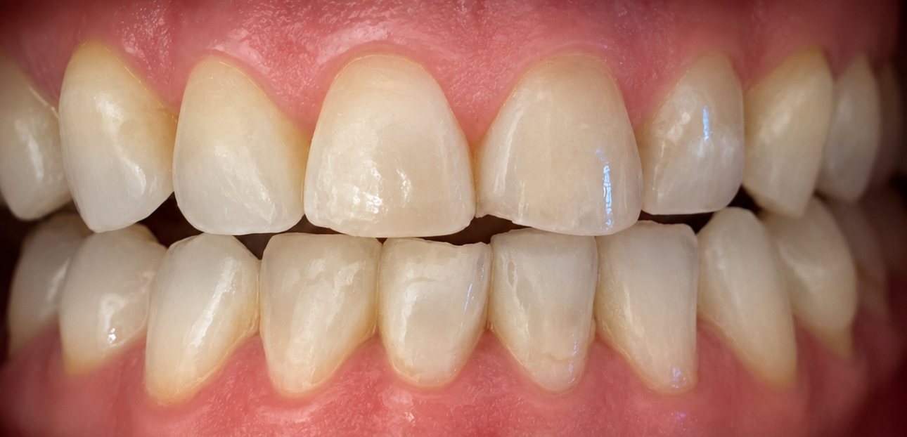 Close-up of a smiling mouth showing crowded, uneven teeth and gums