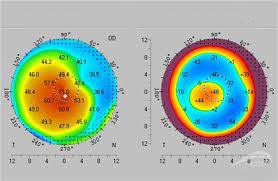 pachimetria corneale