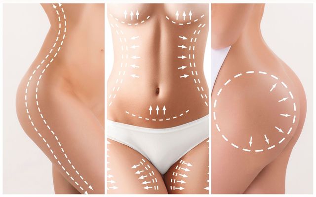 Lipoescultura, cuidados antes y después del procedimiento