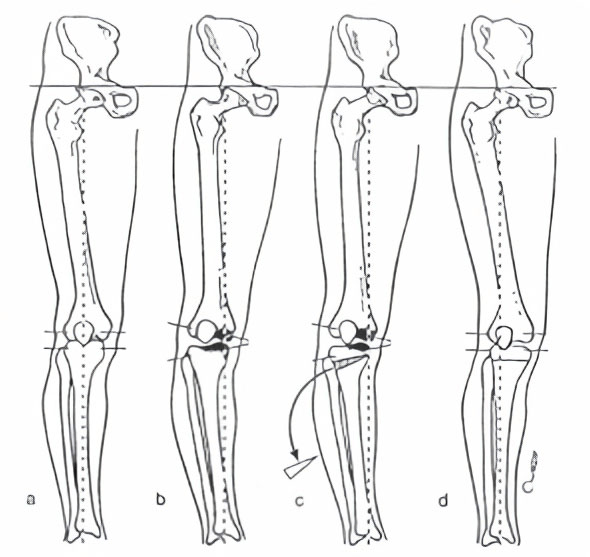 Limb Alignment Surgery | Sydney Orthopaedic and Sports Injury Service