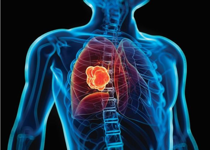 X-ray view of human torso with a large, glowing tumor in the center of the lungs.