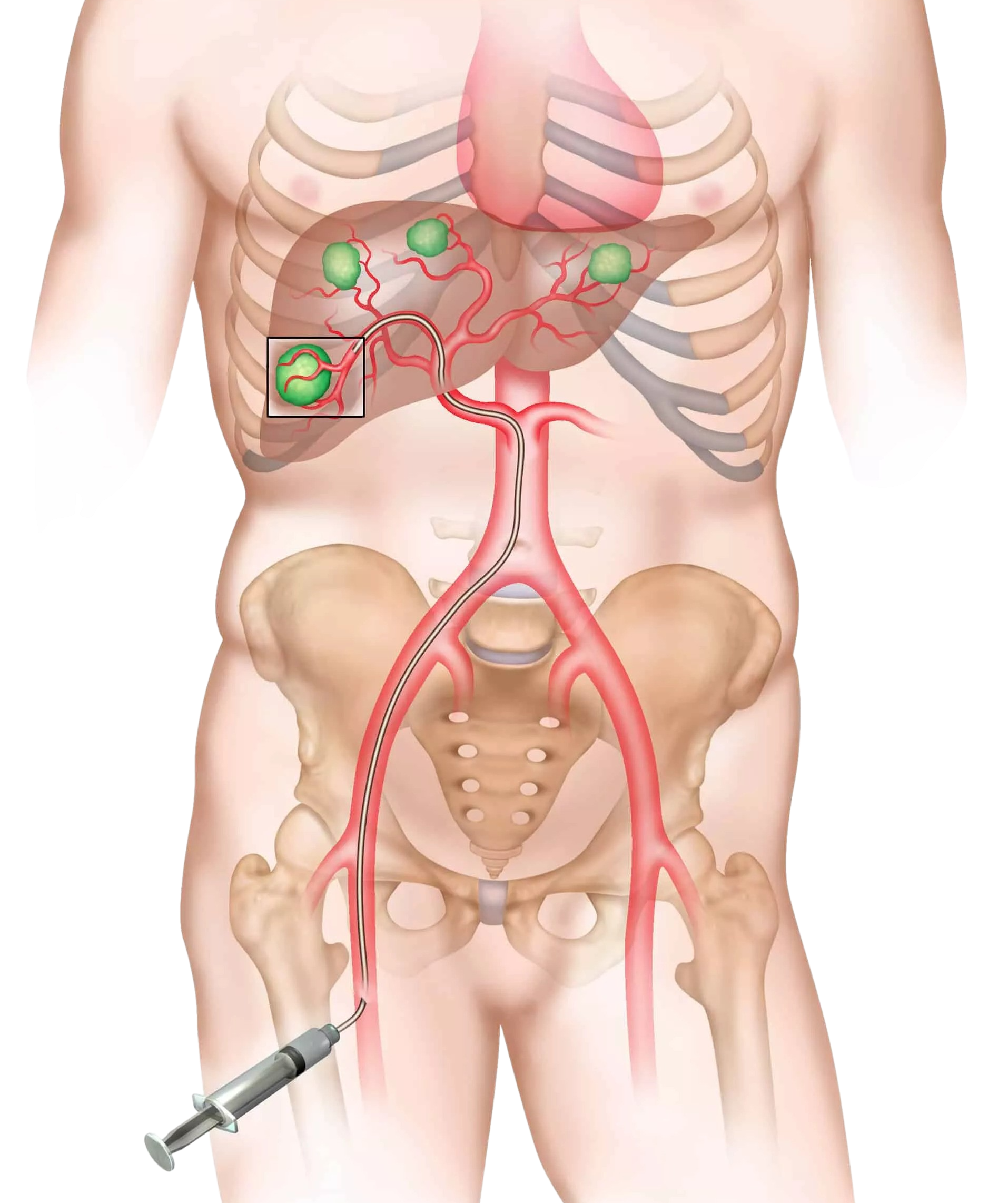 Medical illustration showing a catheter inserted into a patient's femoral artery, reaching the liver to treat cancerous tumors.