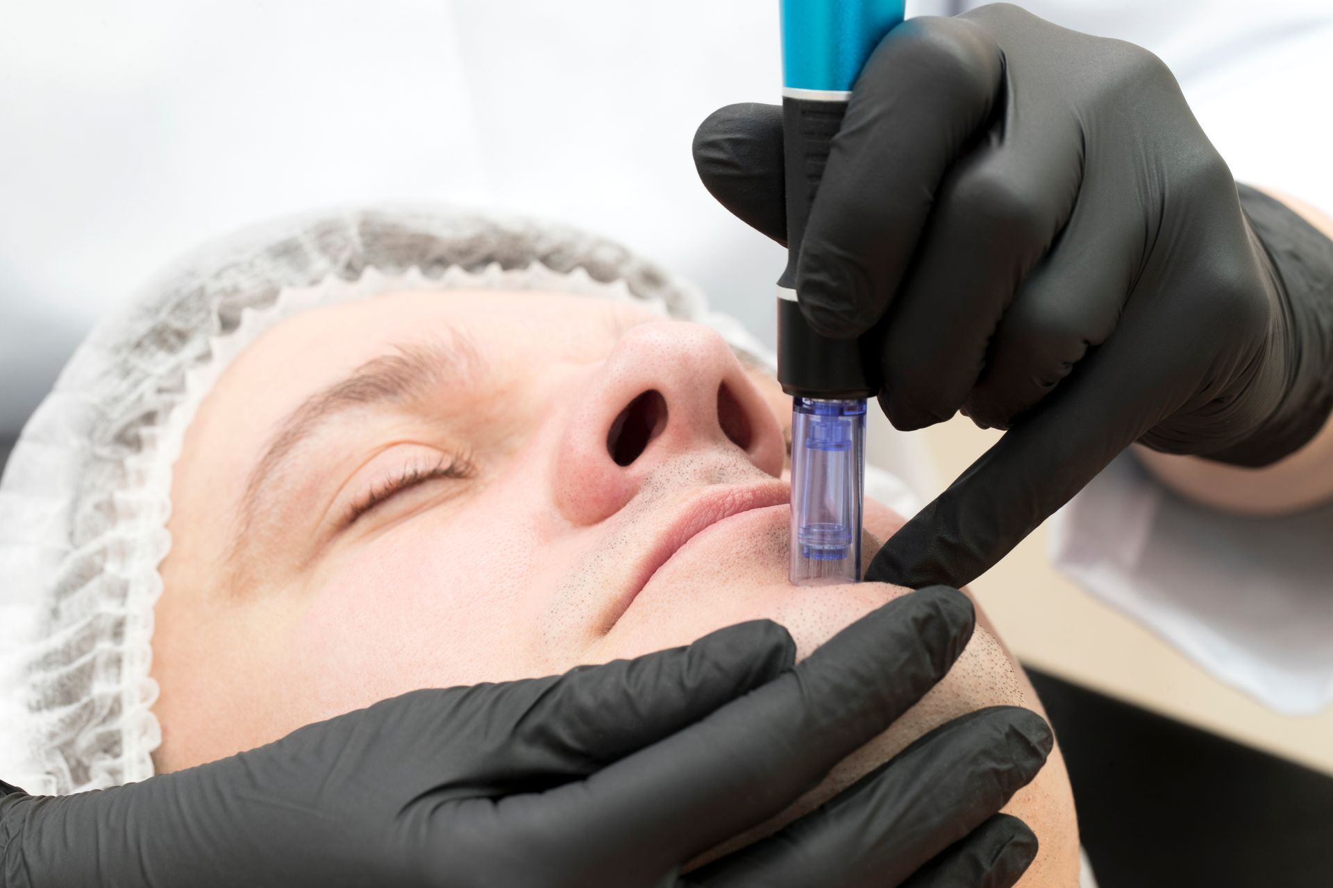A man is getting a microneedle treatment on his face.