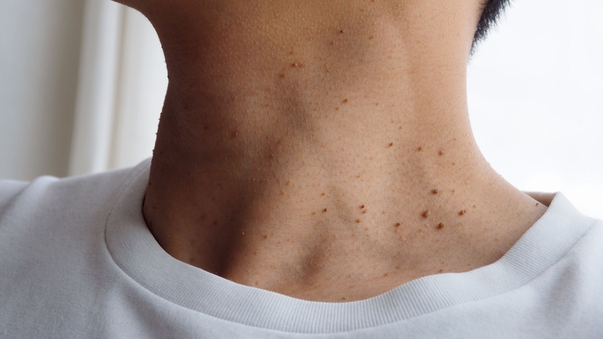 A close up of a man 's neck with black spots on it.