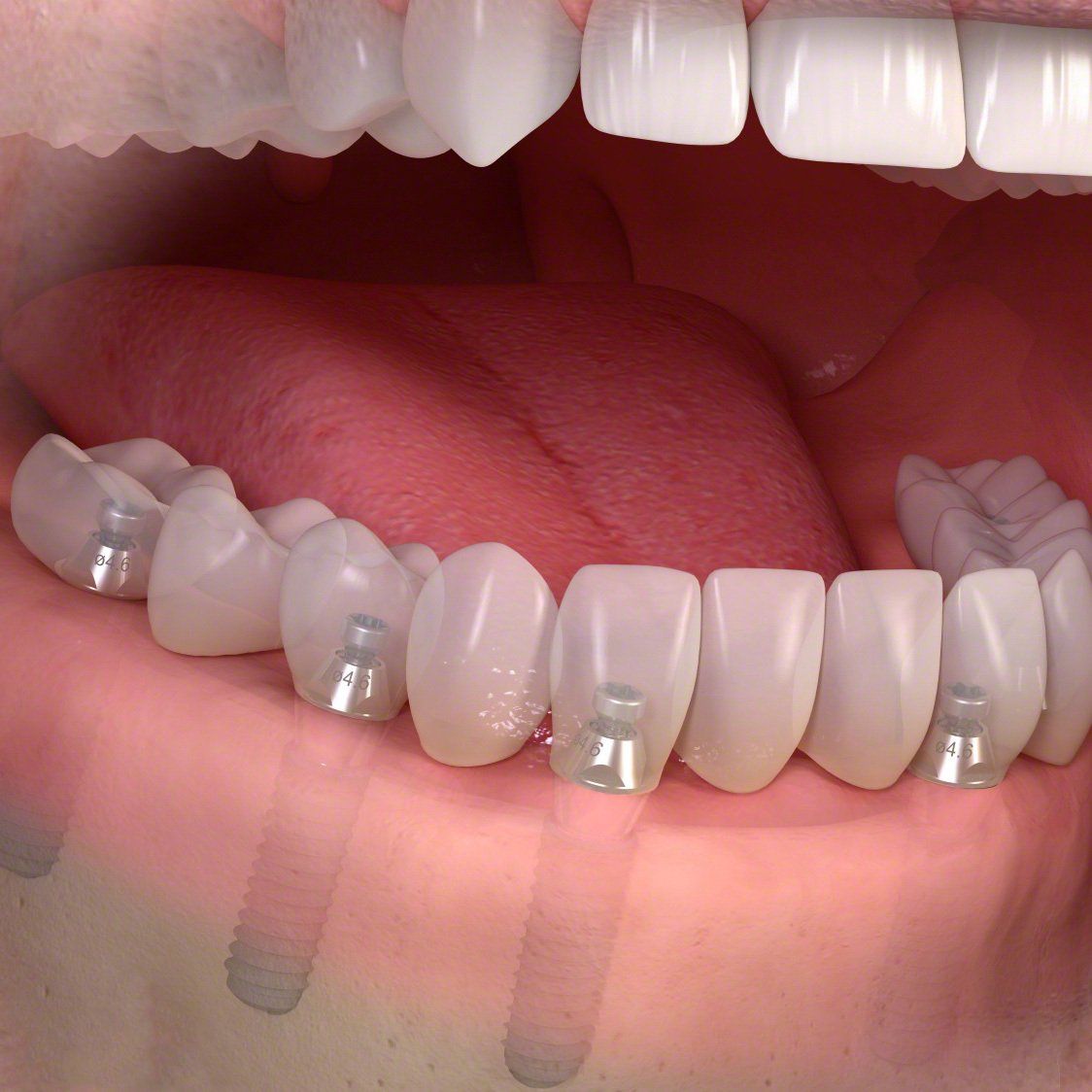 Un primo piano dei denti di una persona con l'apparecchio ortodontico