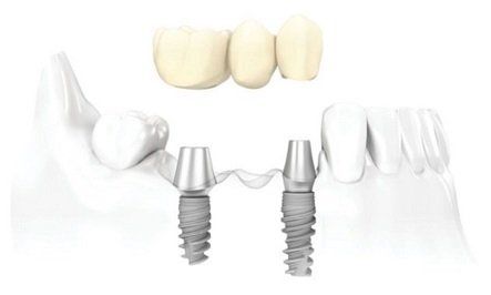 best hawaii practice dental implants