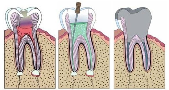 A diagram of a tooth being removed from the gums.