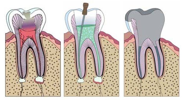 A diagram of a tooth being removed from the gums.