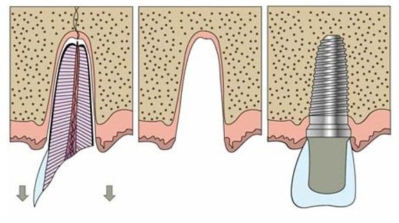 A diagram of a dental implant being placed in a tooth.