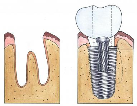 A drawing of a tooth and a dental implant