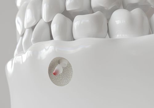 A 3d model of a tooth with a hole in it.