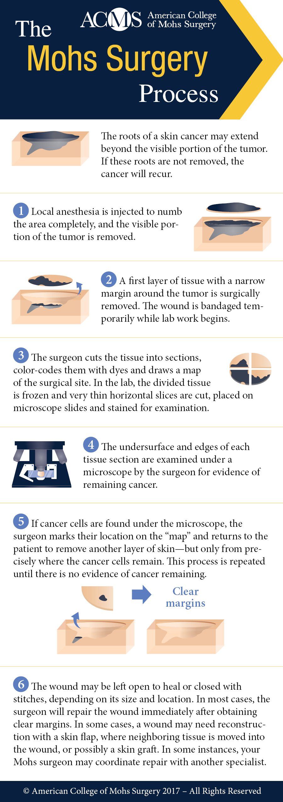 infographic showing the Mohs surgery process