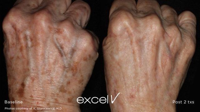 before and after excel v laser on hands