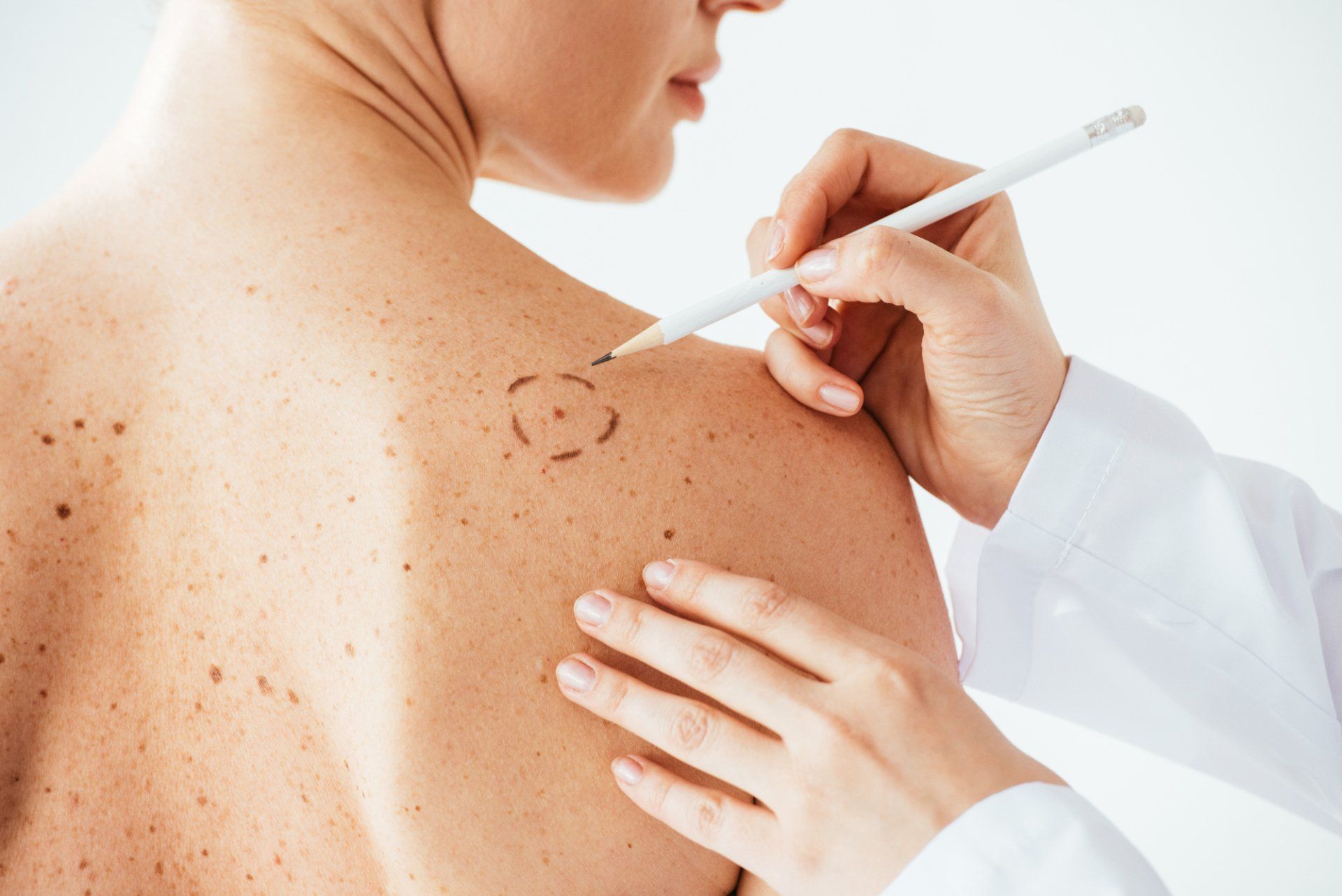 dermatologic surgeon marks mole for removal on female patient's shoulder