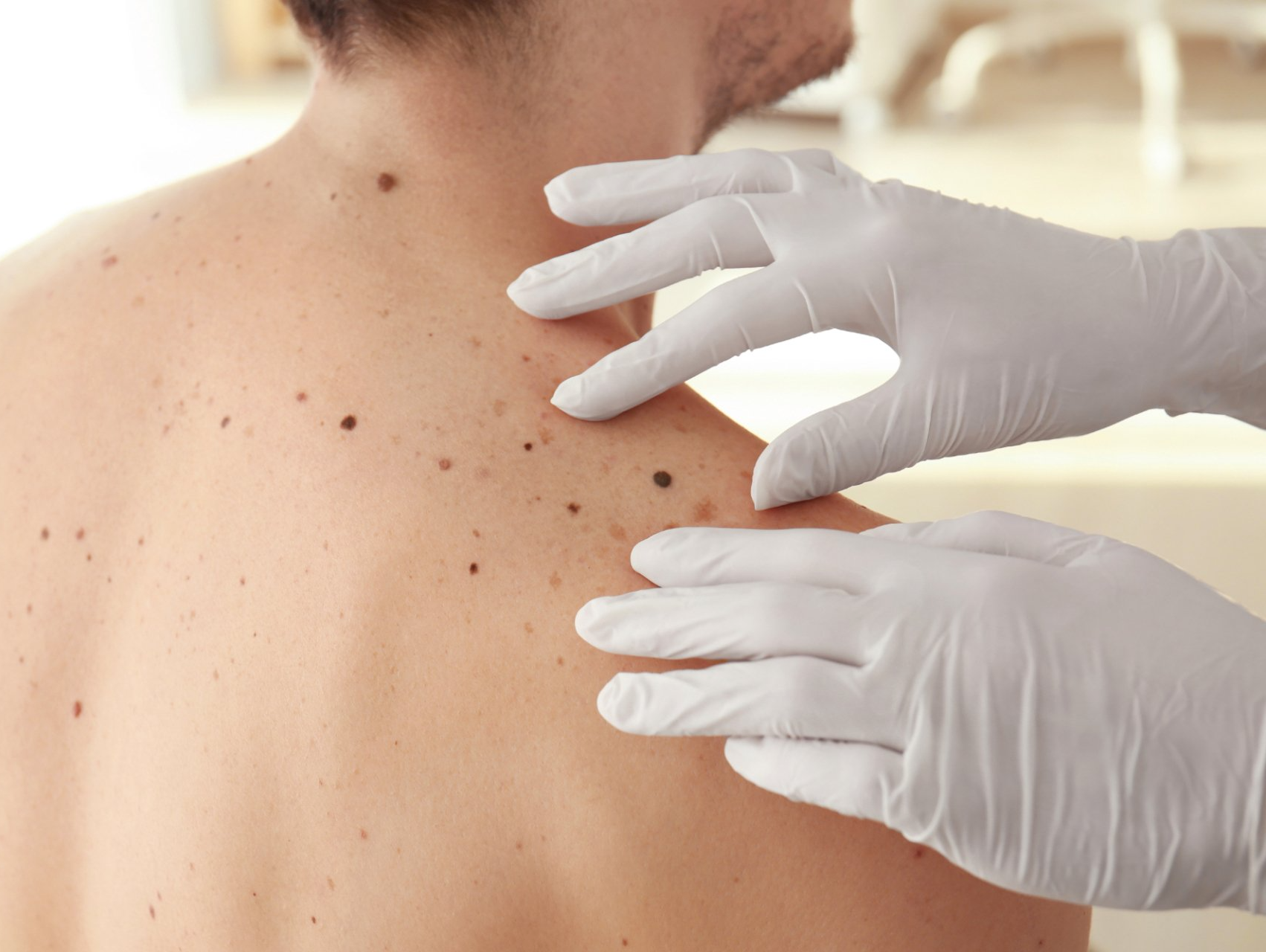 dermatologist examines moles on patient's back