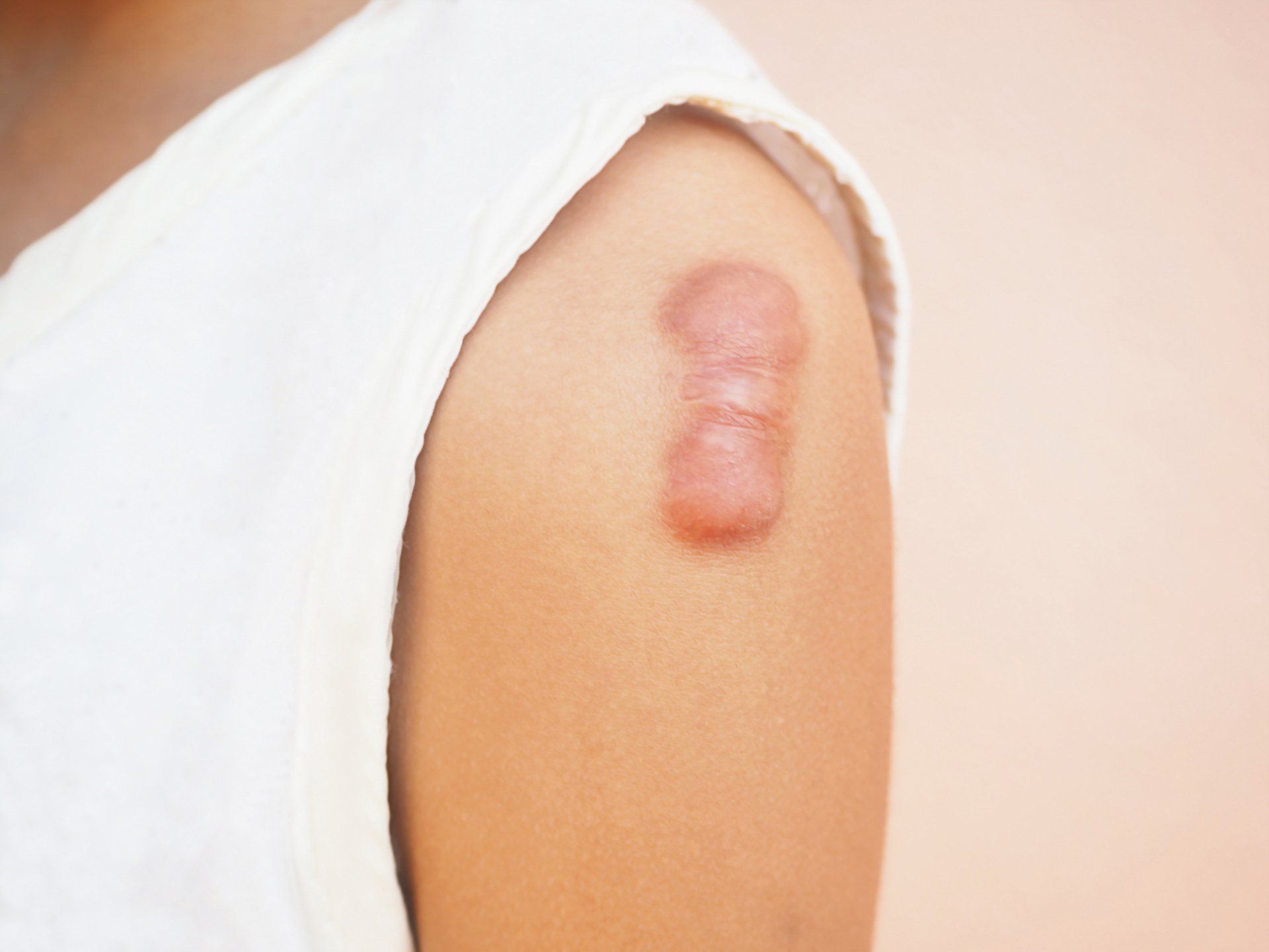 patient with large keloid scar on shoulder