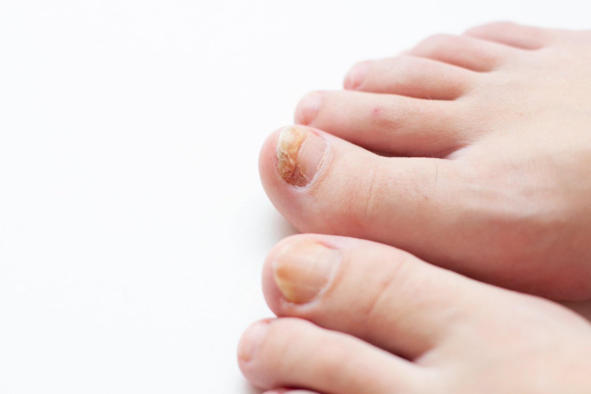 closeup of patient's toes with nail fungus