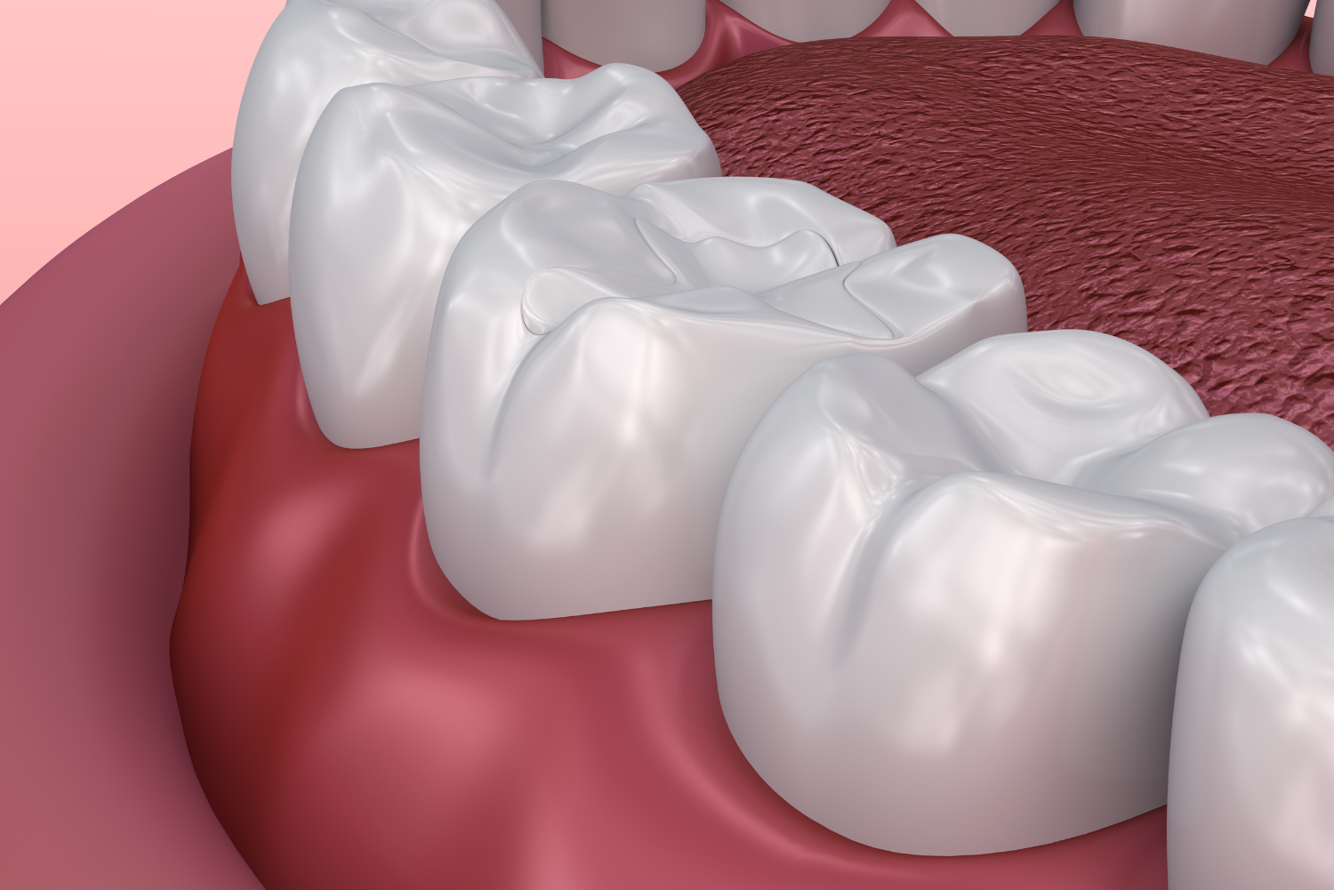 Close-up of a mouth showing several white teeth and red gums.