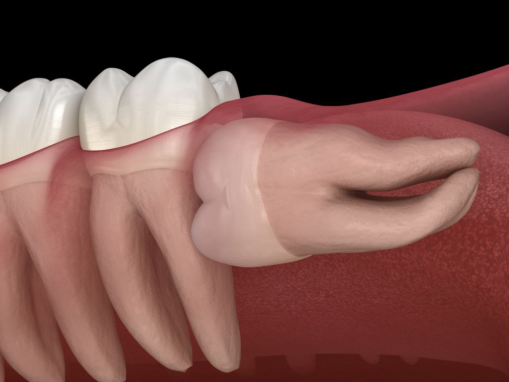 Impacted wisdom tooth in a jaw, with inflamed gums.