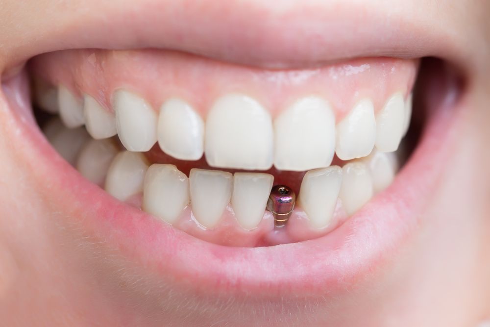 Close-up of a mouth with visible white teeth, and a dental implant post in place of a missing tooth.