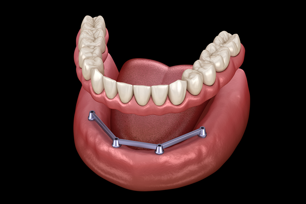 Model of a mouth with dentures attached to a metal bar on the lower jaw.