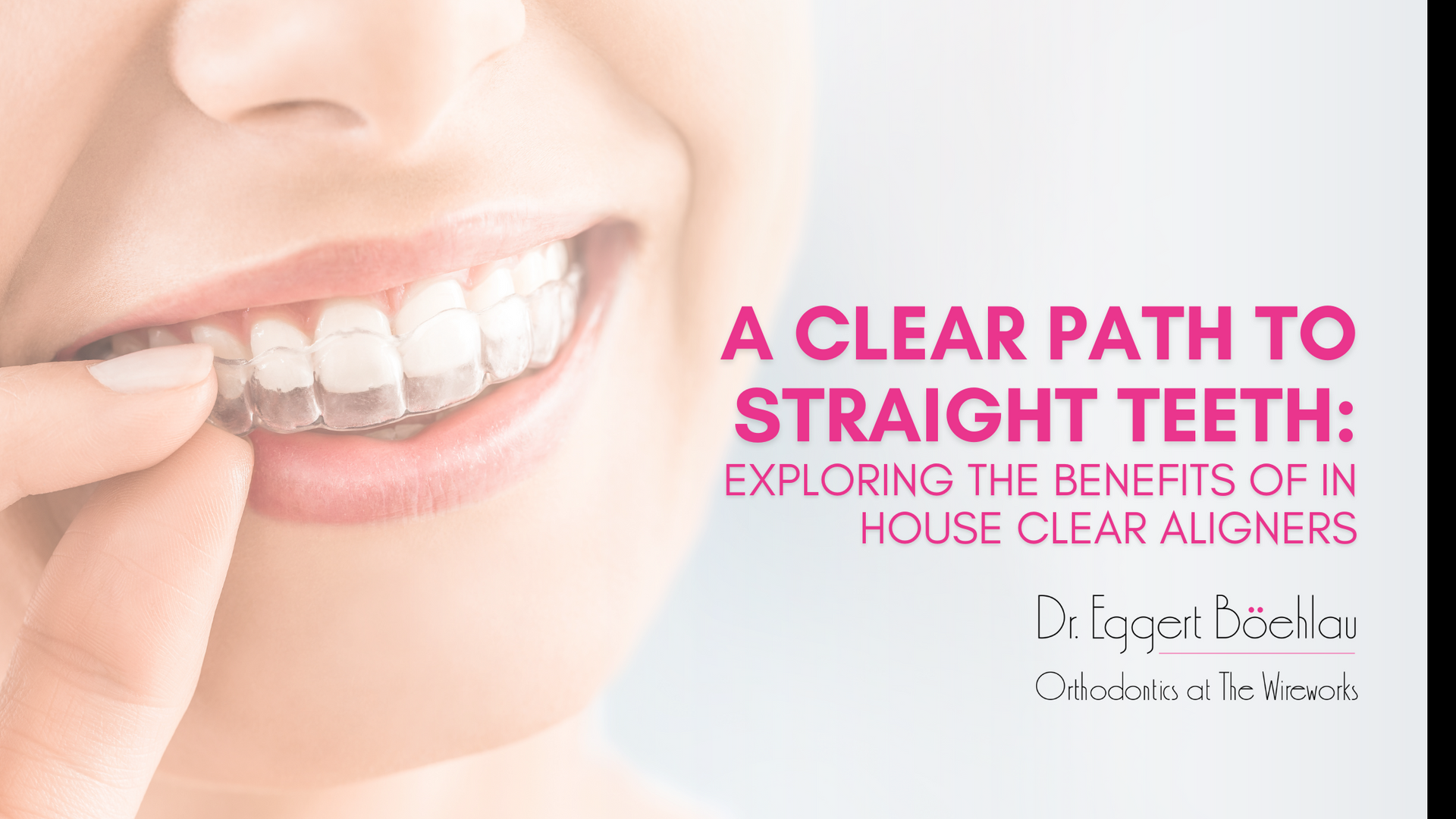 Beautiful Smile and White Teeth with Clear Aligners