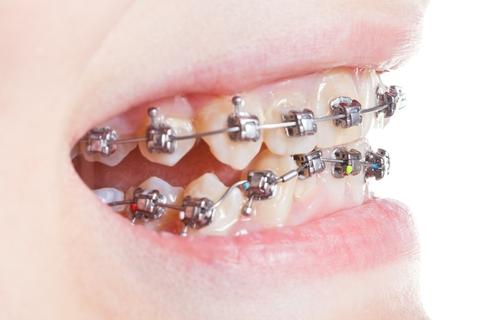 Child With Metal Braces |  Child With Misaligned Teeth | Orthodontics at the Wireworks | Orthodontist In Yorkdale | Orthodontist In Barrie