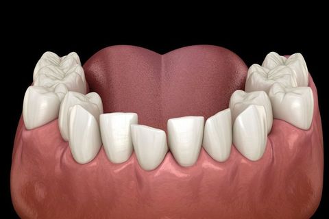 Misaligned Teeth | Lower Teeth | Crowded Teeth | Orthodontic Treatments | Orthodontics at the Wireworks | Orthodontist In Yorkdale | Orthodontist In Barrie