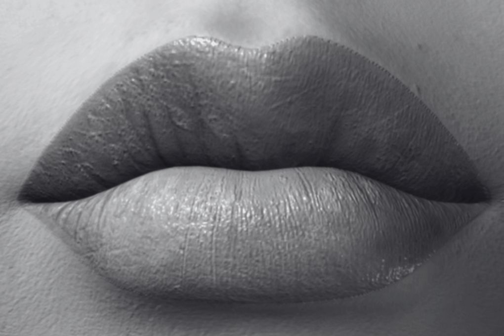 Russian shaped lips after lip augmentation in Leeds