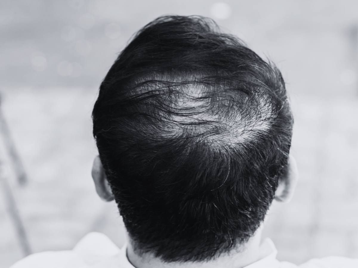 Cleage Clinic using mesotherapy injections for hair restoration in Bradford