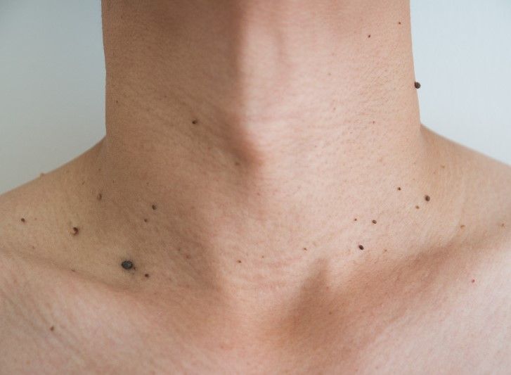 Cleage Clinic a skin tag removal clinic in Horsforth