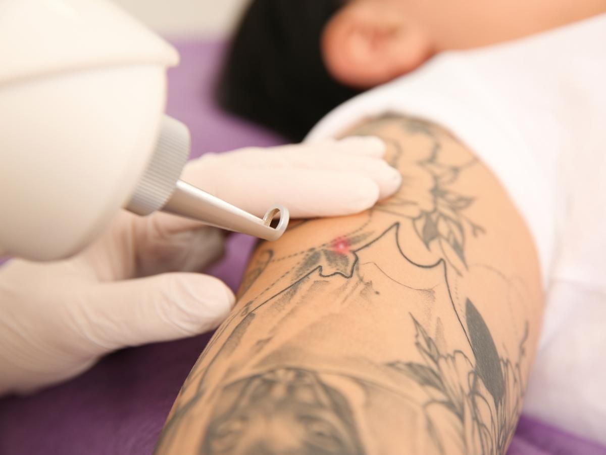 Cleage Clinic laser tattoo removal from arm 