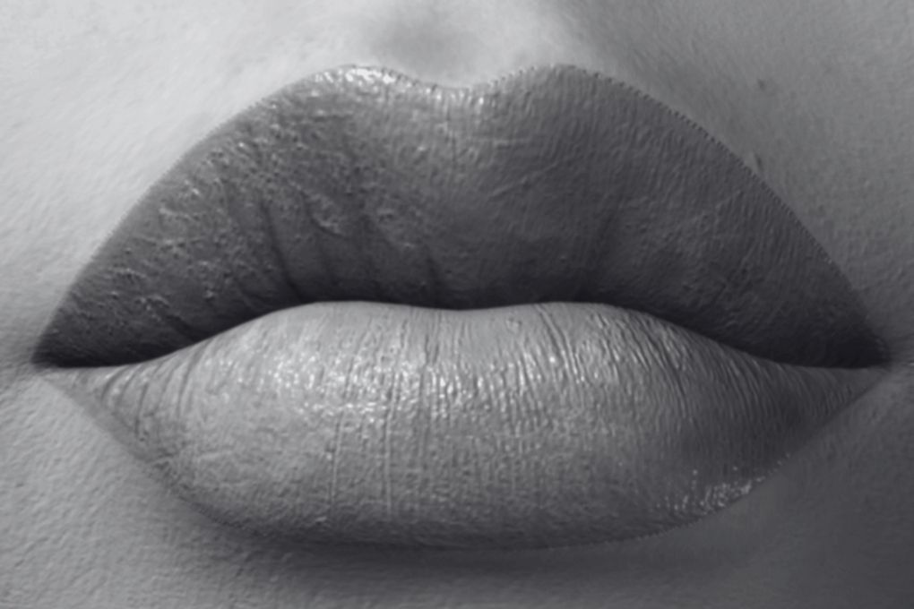 Russian shaped lips after lip augmentation