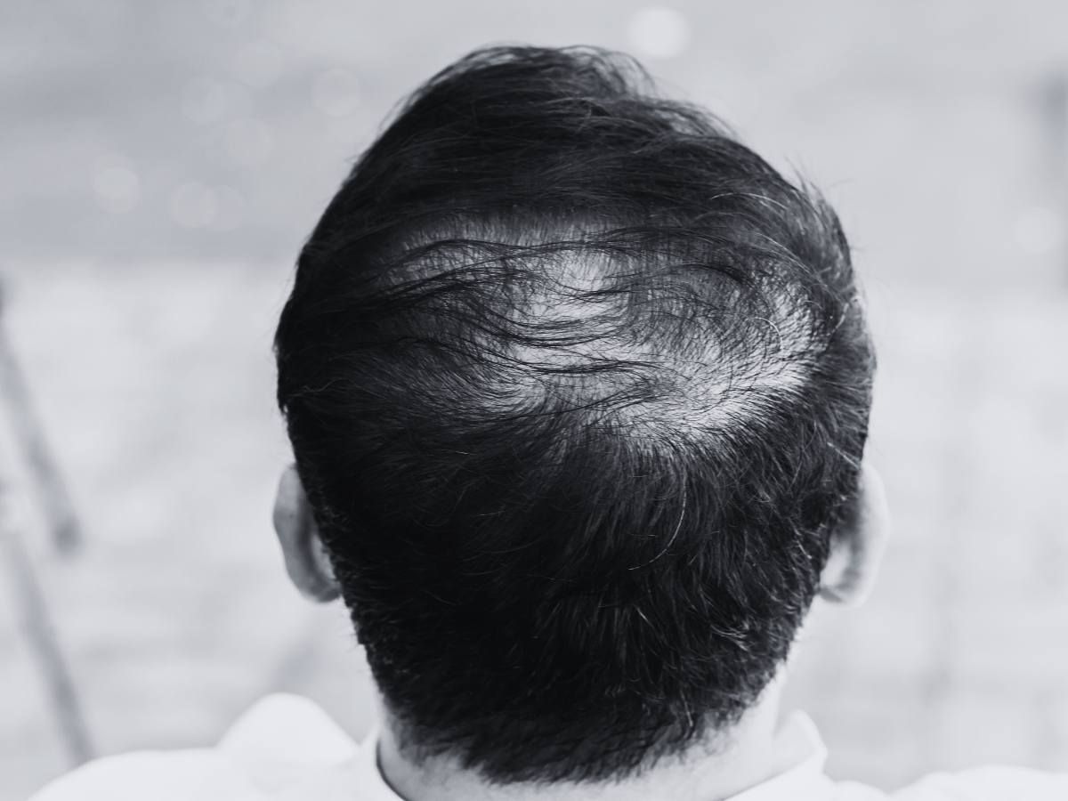 Cleage Clinic using mesotherapy injections for hair restoration