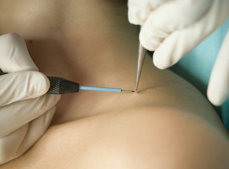 Cleage Clinic carrying out a skin tag removal at Bradford clinic