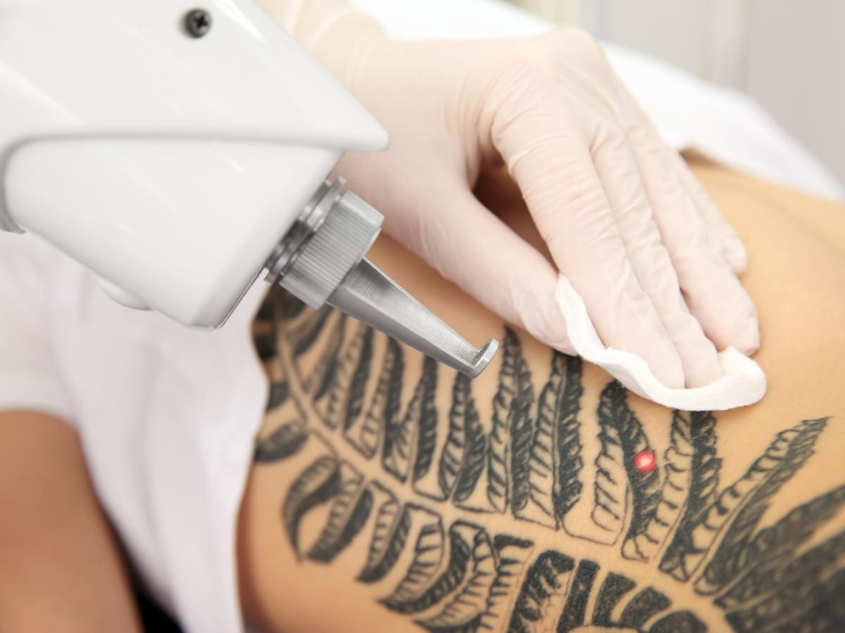 Cleage Clinic tattoo removal Bradford