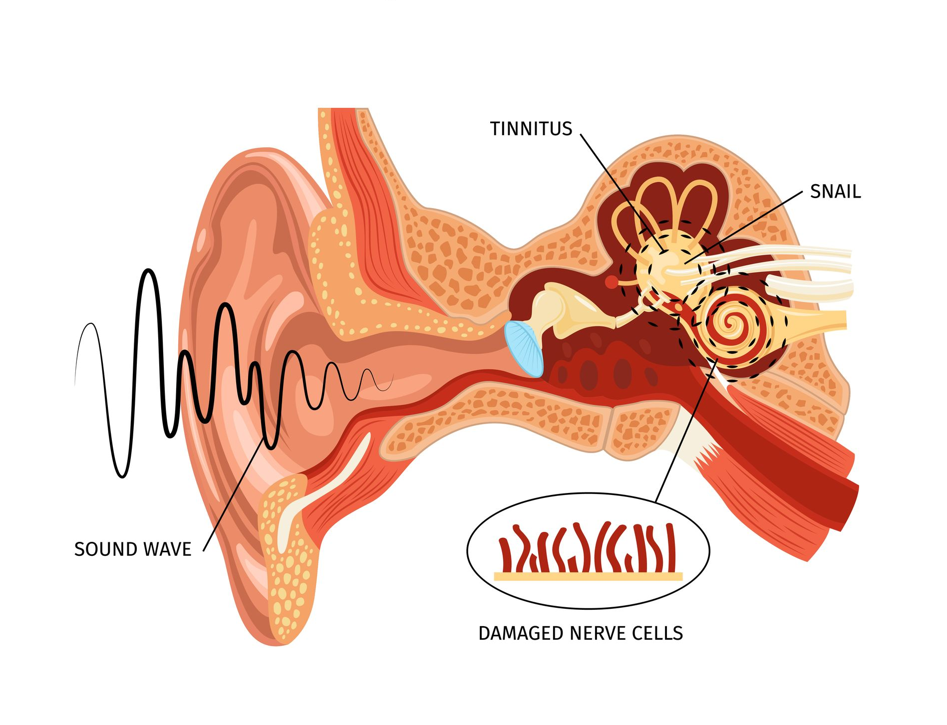 Tværsnitsdiagram af et øre, der viser lydbølger, der trænger ind i og identificerer beskadigede nerveceller forbundet med tinnitus.