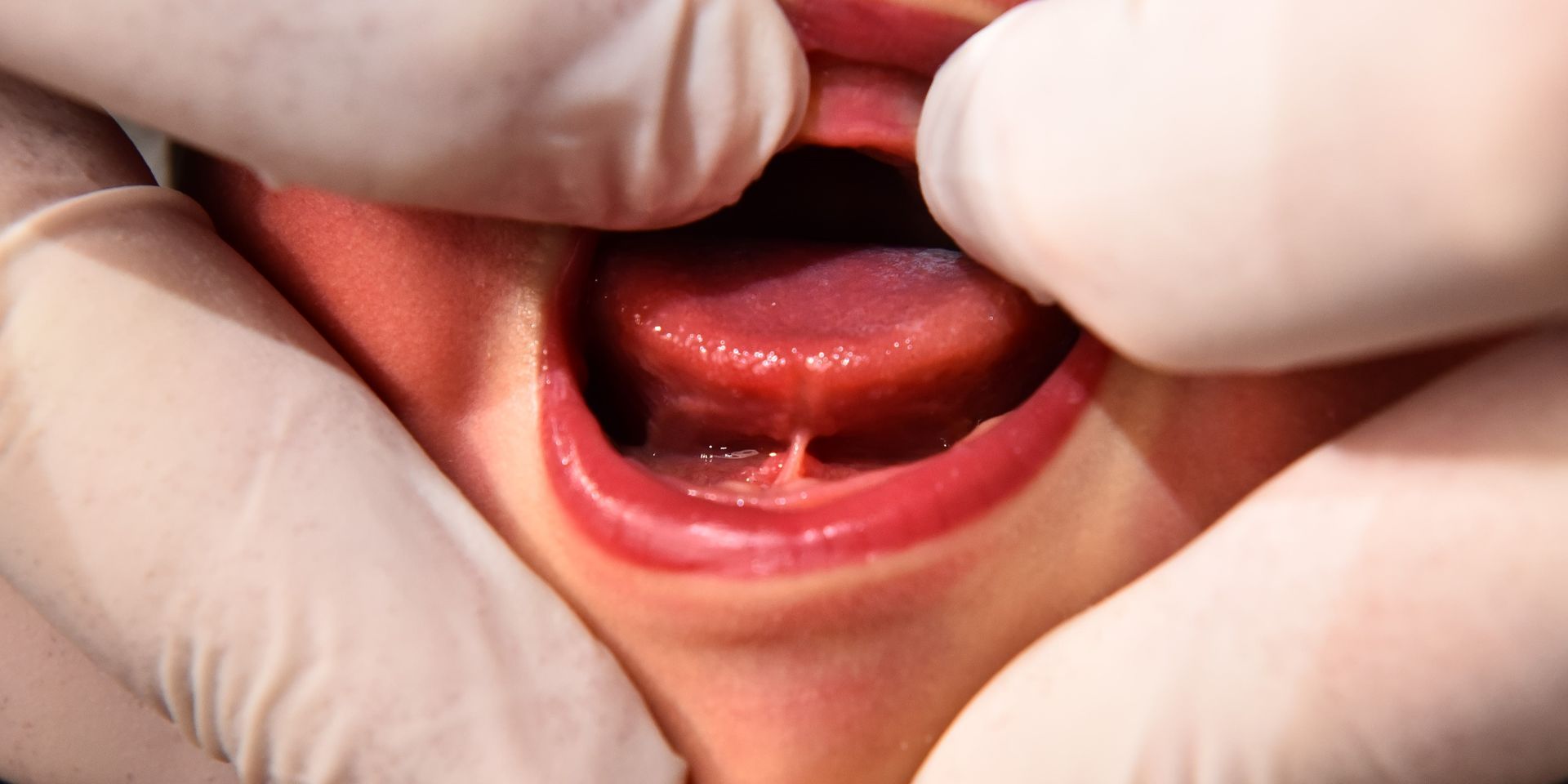 Babys mund undersøges med tandlægeredskaber af handskebeklædte hænder, lys baggrund.