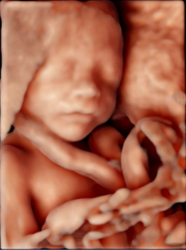 3D scanning af et foster